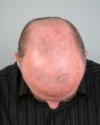 Before Hair Transplant &nbsp;2 Sessions (Areas)